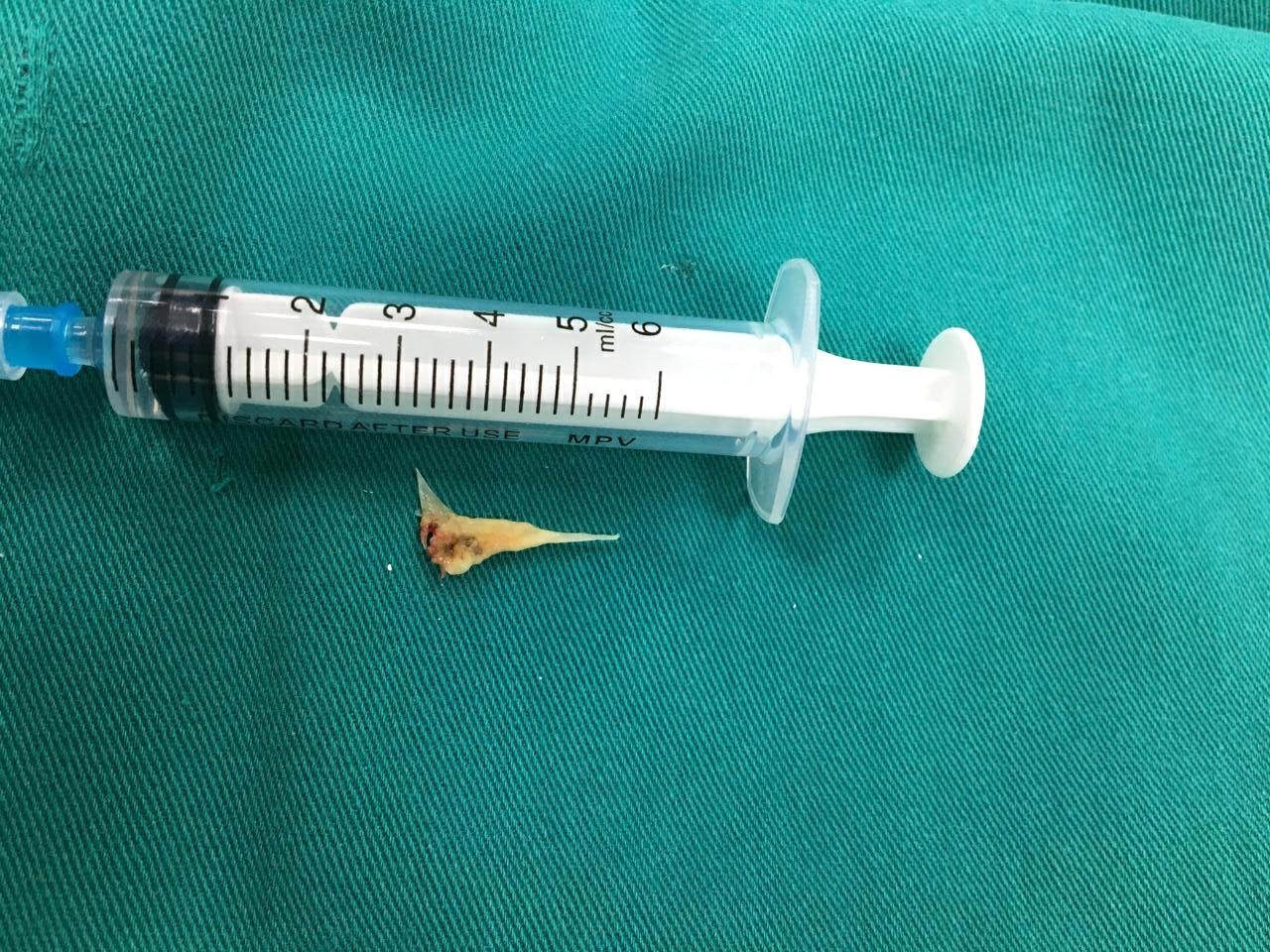 Xuong ca nam trong khi quan benh nhan suot 2 tuan hinh anh