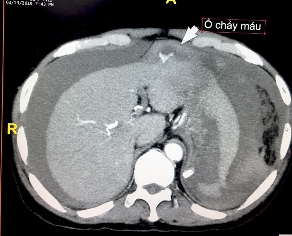 Người đàn ông bị ngã mới phát hiện bị u gan ảnh 2 Nguoi dan ong bi nga moi phat hien bi u gan anh 2