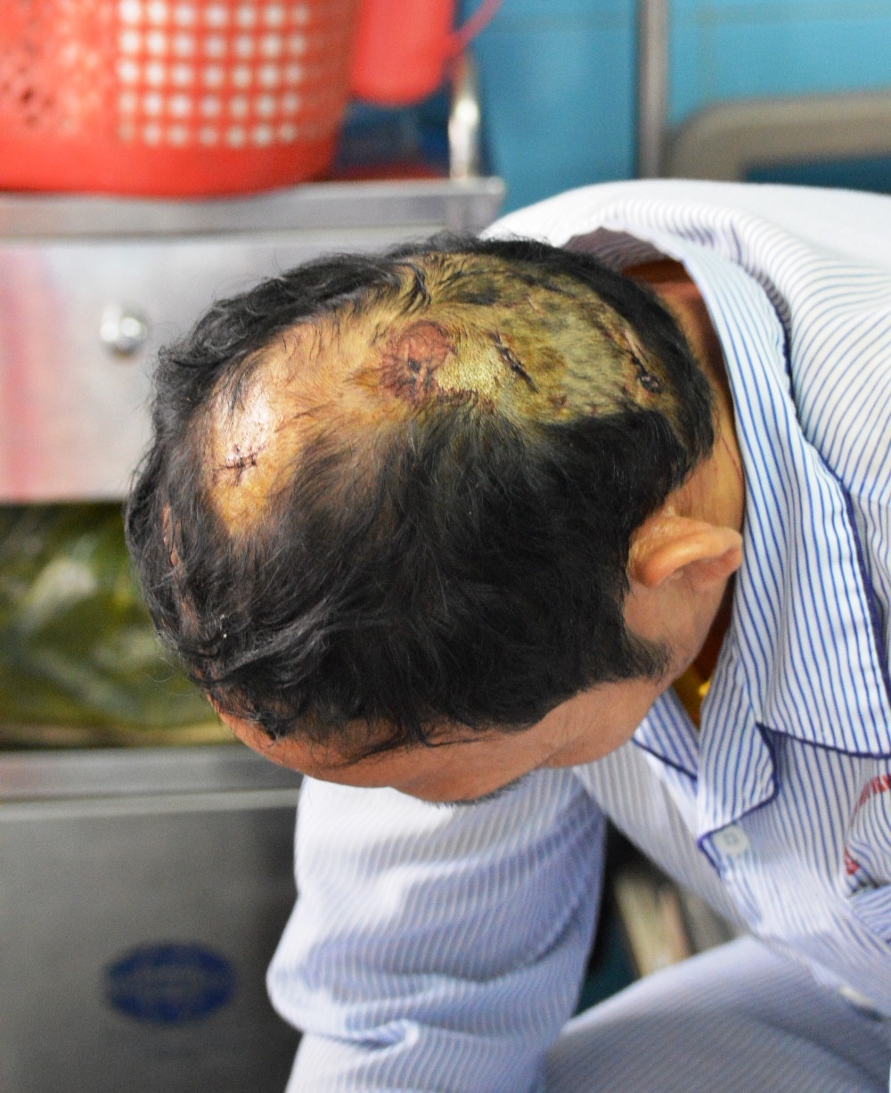 Phần đầu anh Tường bị nhiều vết thương, trong đó có hai vết đâm khá sâu rất nguy hiểm