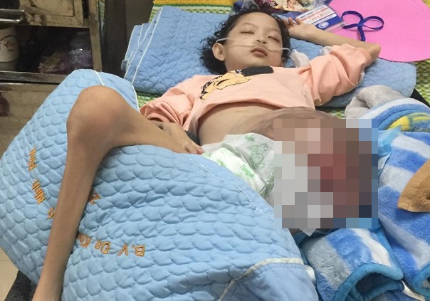 Bé gái 10 tuổi mắc ung thư xương ảnh 1 Be gai 10 tuoi mac ung thu xuong anh 1