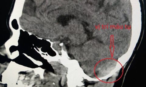 vỡ gan,  tai nạn giao thông,  tai nạn giao thông do say rượu  ảnh 1 vo gan,  tai nan giao thong,  tai nan giao thong do say ruou anh 1