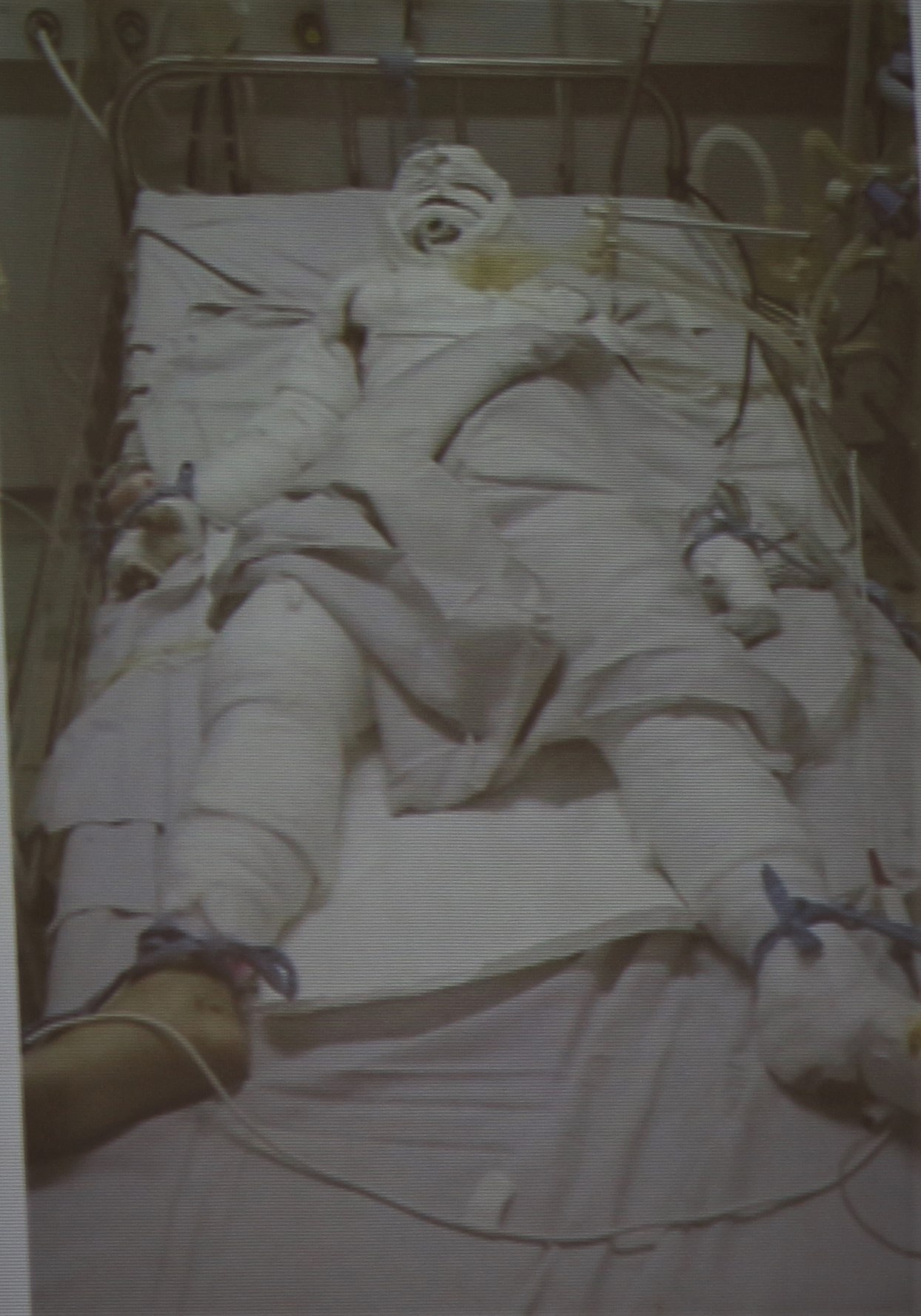 cha hút thuốc con bị bỏng ảnh 1 cha hut thuoc con bi bong anh 1