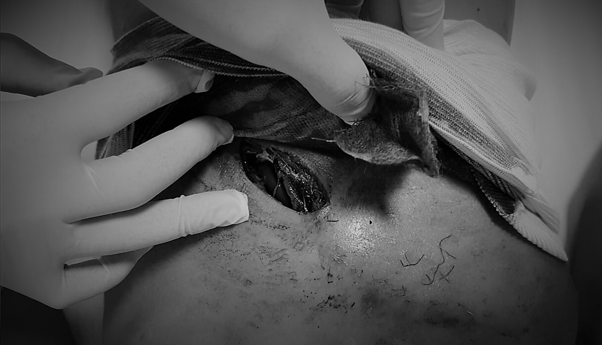 may cat lua dam thau nguc bung,  be trai truot nga bi dam xuyen nguc anh 1