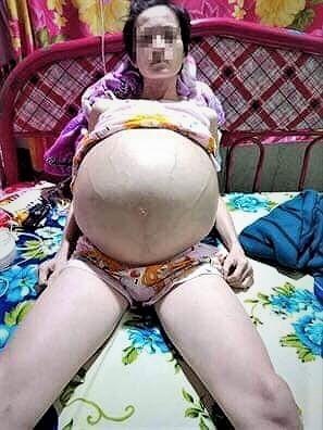 khoi u khong lo trong bung,  boc khoi u nang 25 kg trong bung anh 1