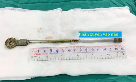 Be trai bi thanh sat dam xuyen mi mat chui vao trong nao hinh anh