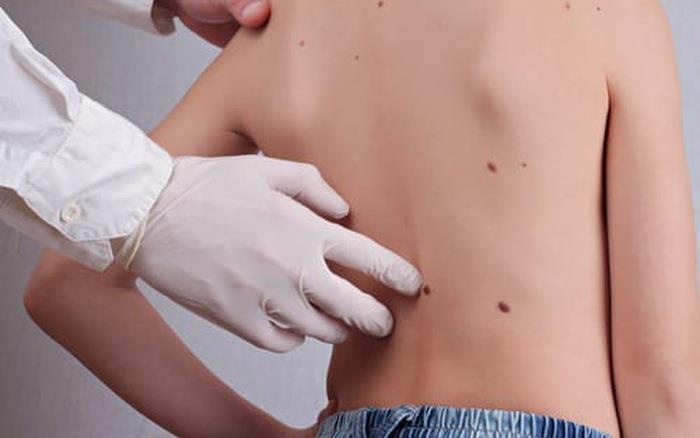 Be trai 7 tuoi mang khoi u hac to khong lo tren lung nhu chiec mai rua hinh anh