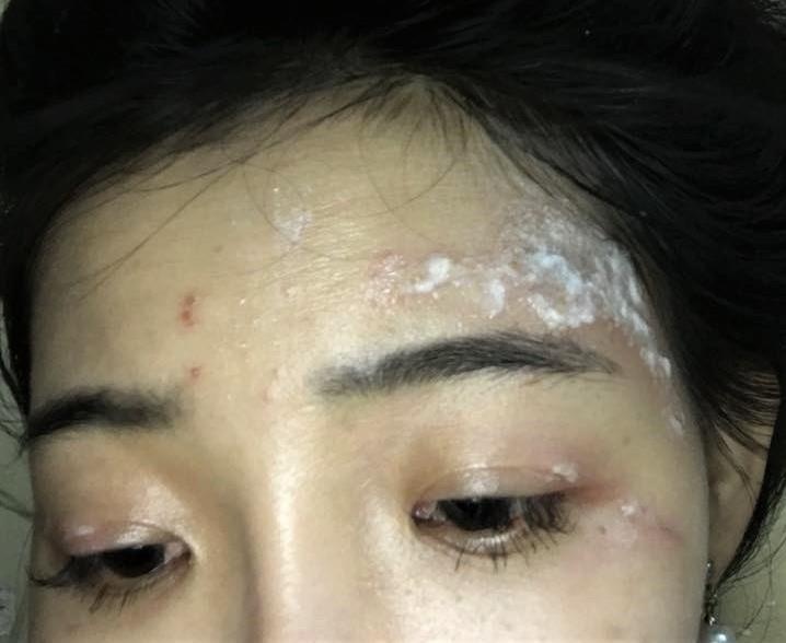 sinh viên KTX bị kiến ba khoang cắn ảnh 2 sinh vien KTX bi kien ba khoang can anh 2