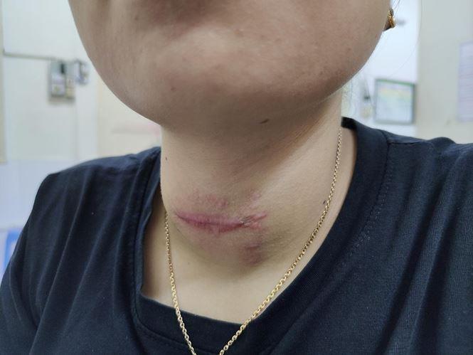 thầy lang đấp thuốc chữa bệnh Basedow ảnh 2 thay lang dap thuoc chua benh Basedow anh 2