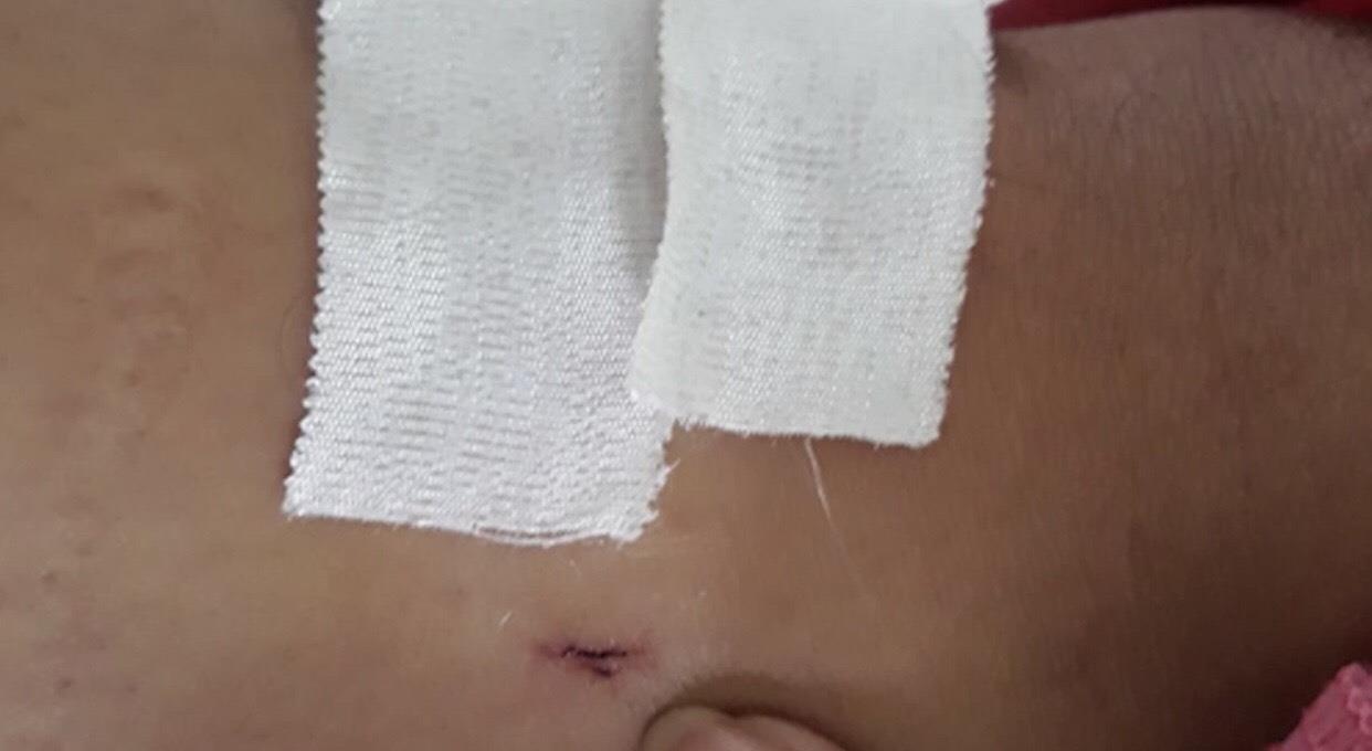 bệnh nhân gãy đốt sống cổ bị khoan nhầm chân  ảnh 2 benh nhan gay dot song co bi khoan nham chan anh 2