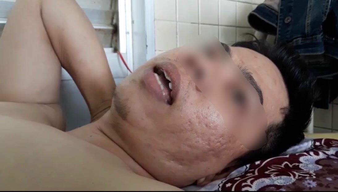 khoan nham cang chan cho benh nhan gay dot song nguc anh 1