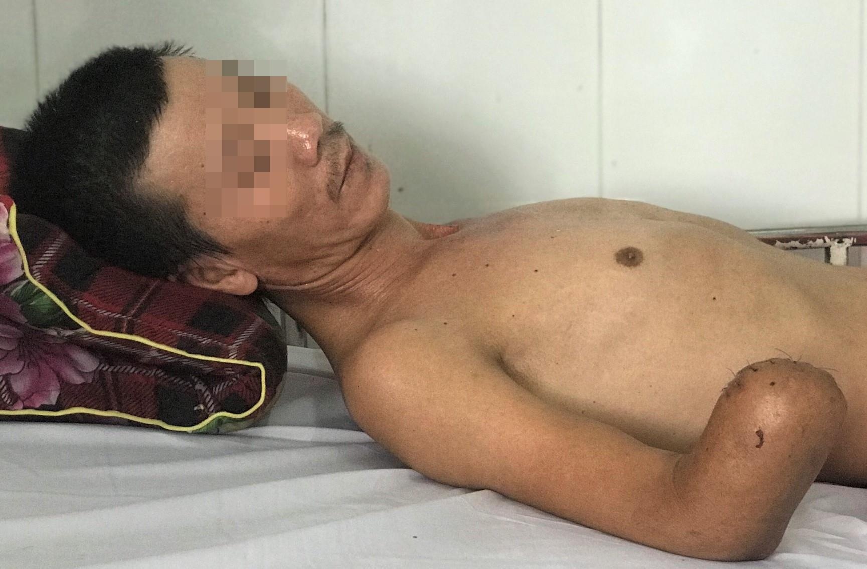 Hai thanh nien phai cat bo tu chi vi bi dien cao the giat hinh anh
