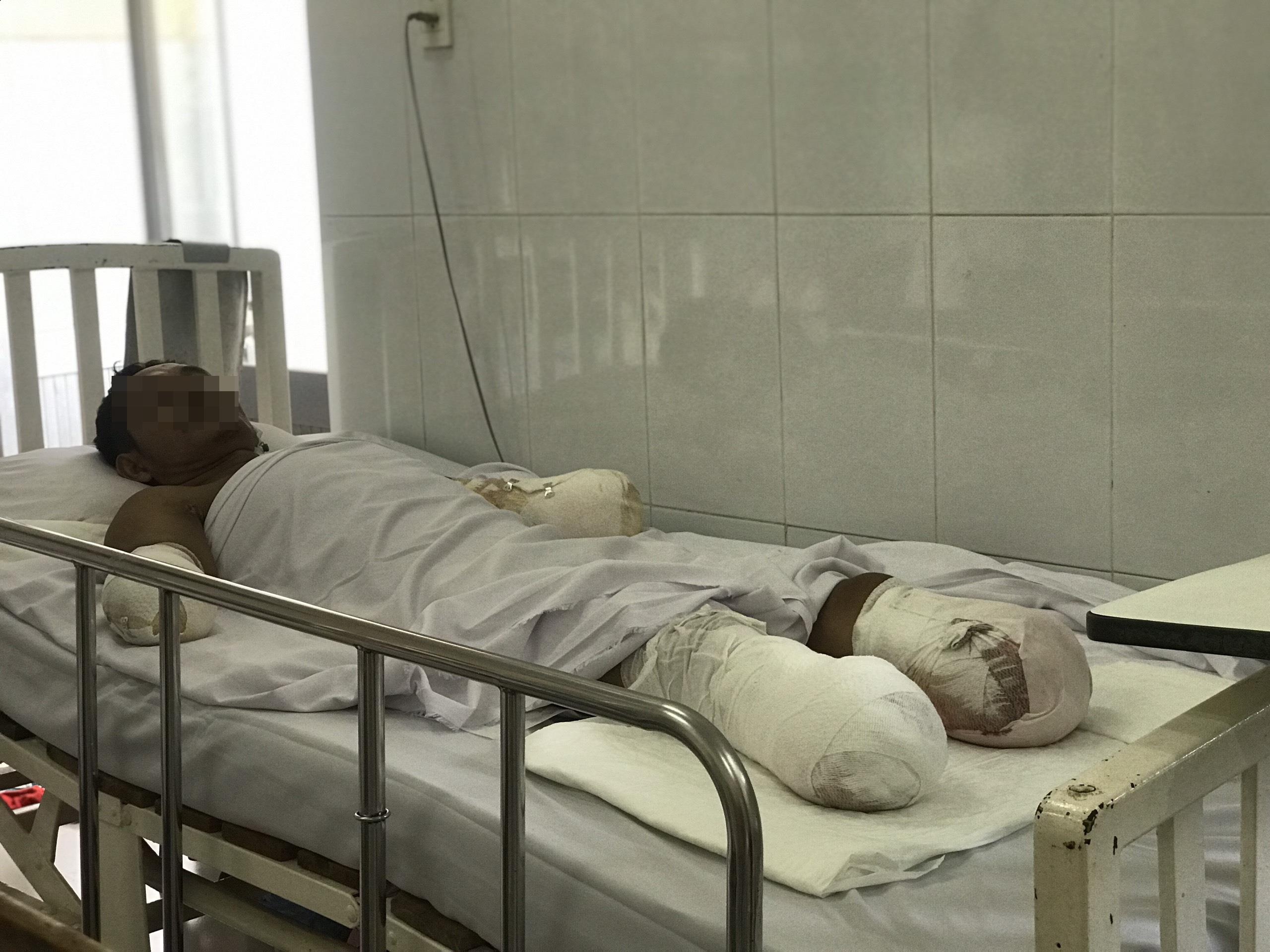 bỏng điện cao thế ảnh 1 bong dien cao the anh 1