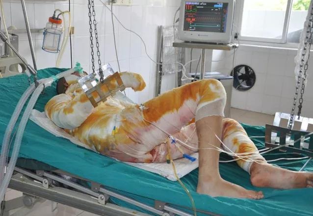 nướng mực bị bỏng cồn ảnh 1 nuong muc bi bong con anh 1