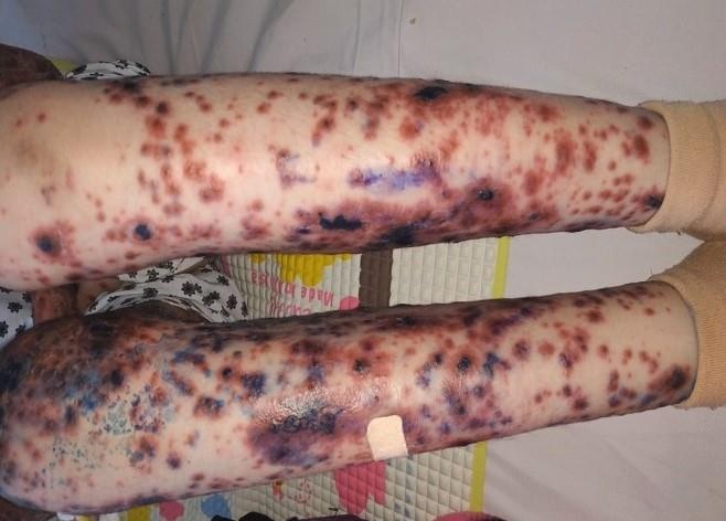 bé gái mắc bệnh Mucha–Habermann ảnh 1 be gai mac benh Mucha–Habermann anh 1