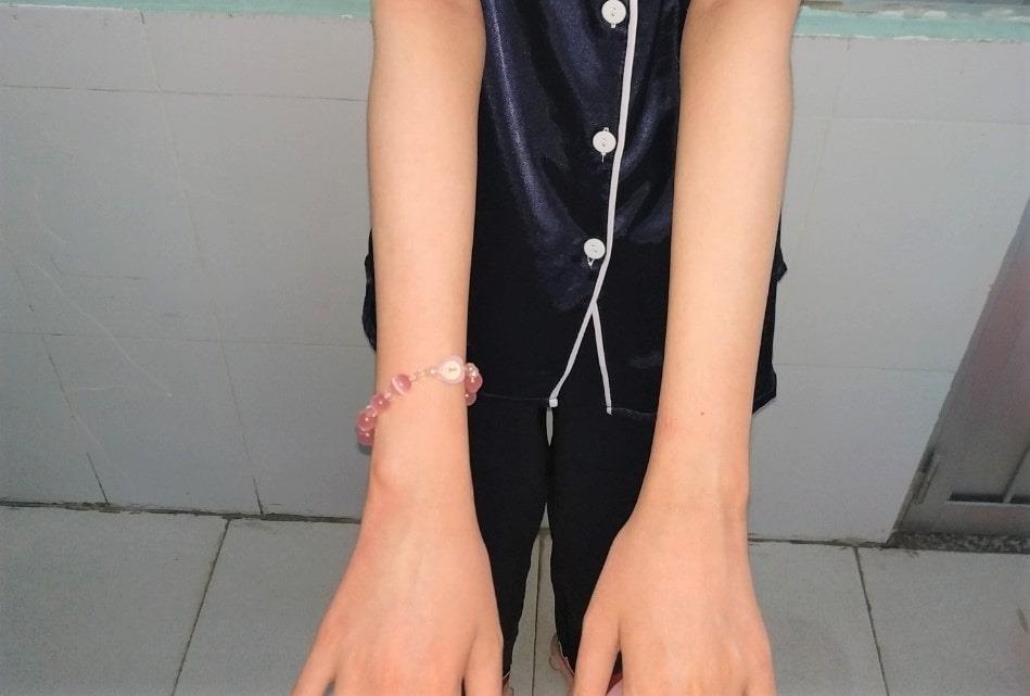 bé gái mắc bệnh Mucha–Habermann ảnh 2 be gai mac benh Mucha–Habermann anh 2