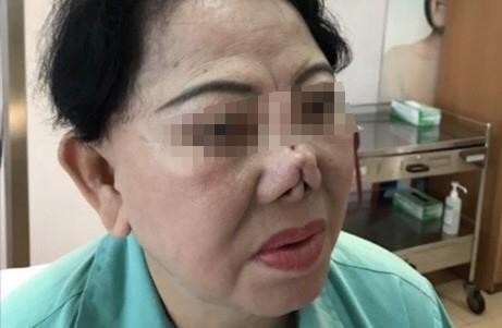 bien chung khi phau thuat nang mui anh 1