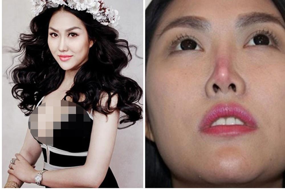 bien chung khi phau thuat nang mui anh 2