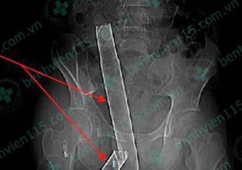 Nam thanh nien bi thanh inox dai hon 1,1 m dam xuyen mong hinh anh