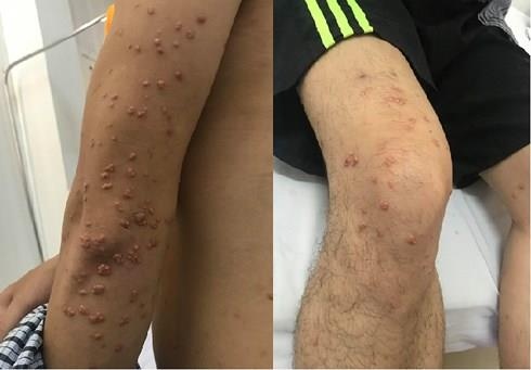u lạ mọc khắp người vì rượu bia ảnh 2 u la moc khap nguoi vi ruou bia anh 2