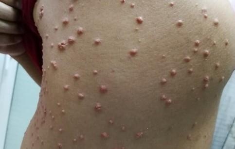 u lạ mọc khắp người vì rượu bia ảnh 1 u la moc khap nguoi vi ruou bia anh 1