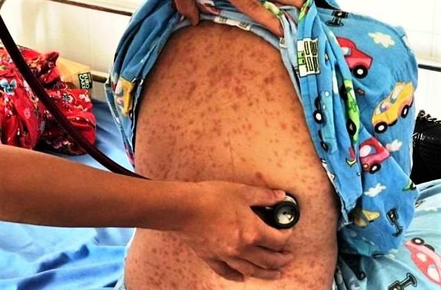 sởi biến chứng nặng do không tiêm vắc xin ảnh 1 soi bien chung nang do khong tiem vac xin anh 1