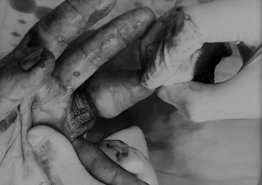 suyt mat ngon tay vi deo nhan anh 1