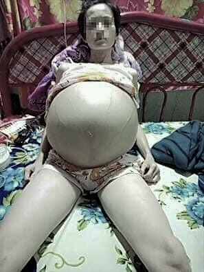 ung thu buong trung bung to nhu mang thai anh 1