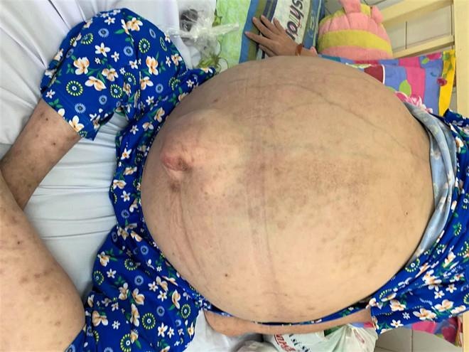 Nguyen nhan khien co gai 19 tuoi bi u 40 lit nuoc trong bung hinh anh