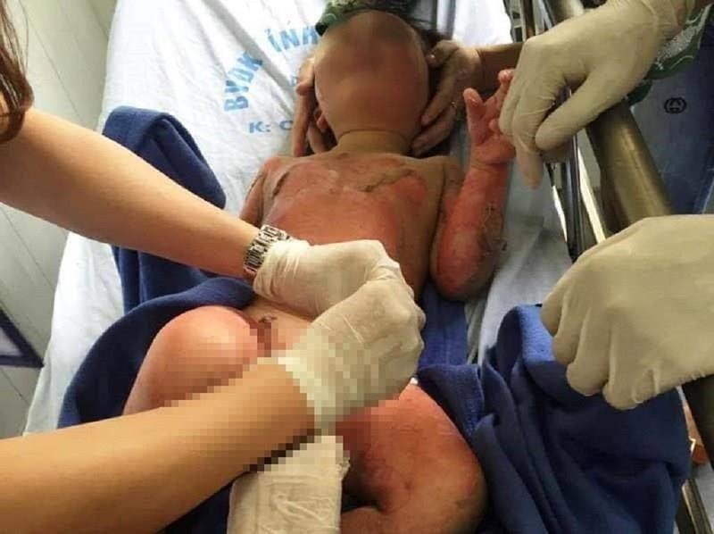 3 bé mầm non bỏng cồn  ảnh 1 3 be mam non bong con anh 1