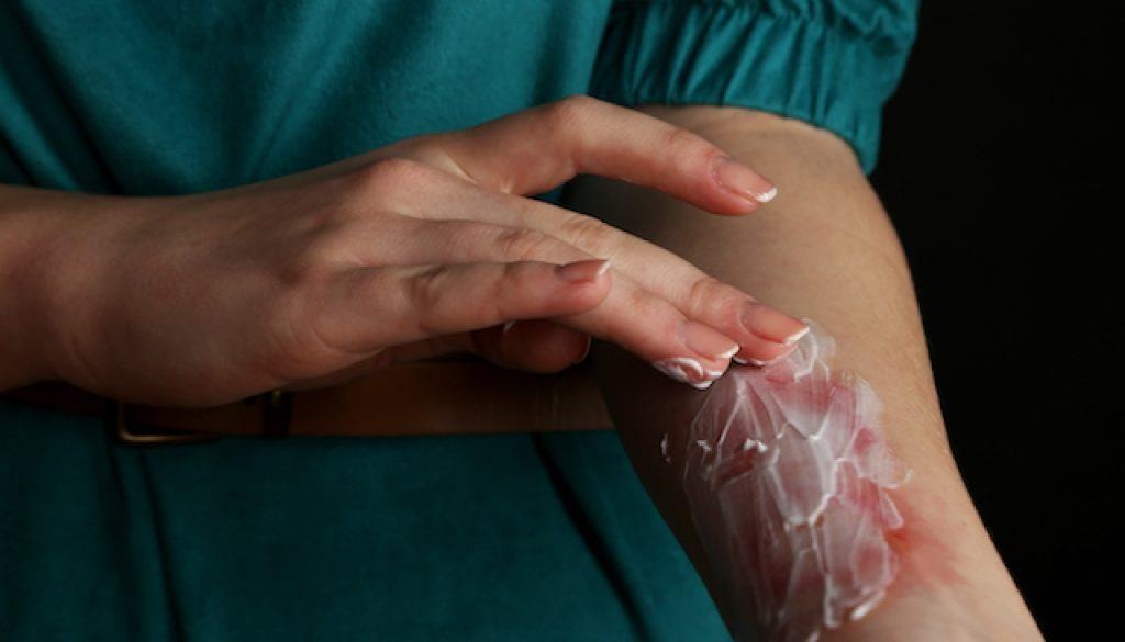 sơ cứu người bị bỏng ảnh 1 so cuu nguoi bi bong anh 1