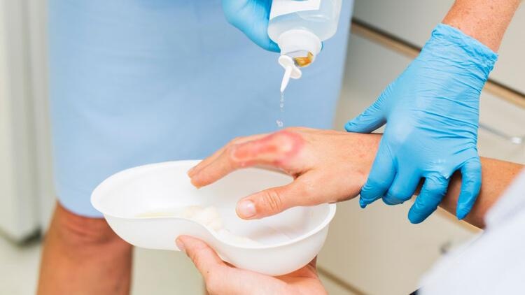 sơ cứu người bị bỏng ảnh 2 so cuu nguoi bi bong anh 2