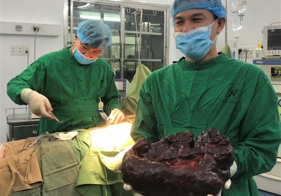 Bac si lan dau gap khoi u lach nang hon 5 kg hinh anh