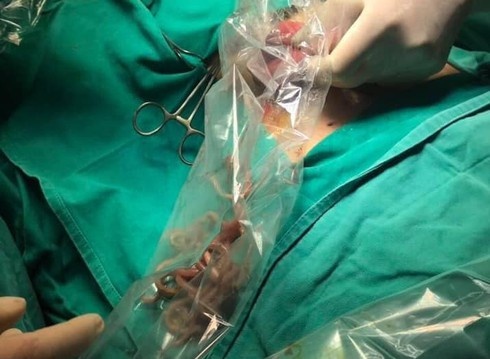 bui giun 100 con gay tac ruot anh 1