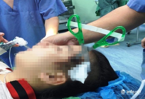 kéo nhọn găm vào đầu xuyên não ảnh 1 keo nhon gam vao dau xuyen nao anh 1