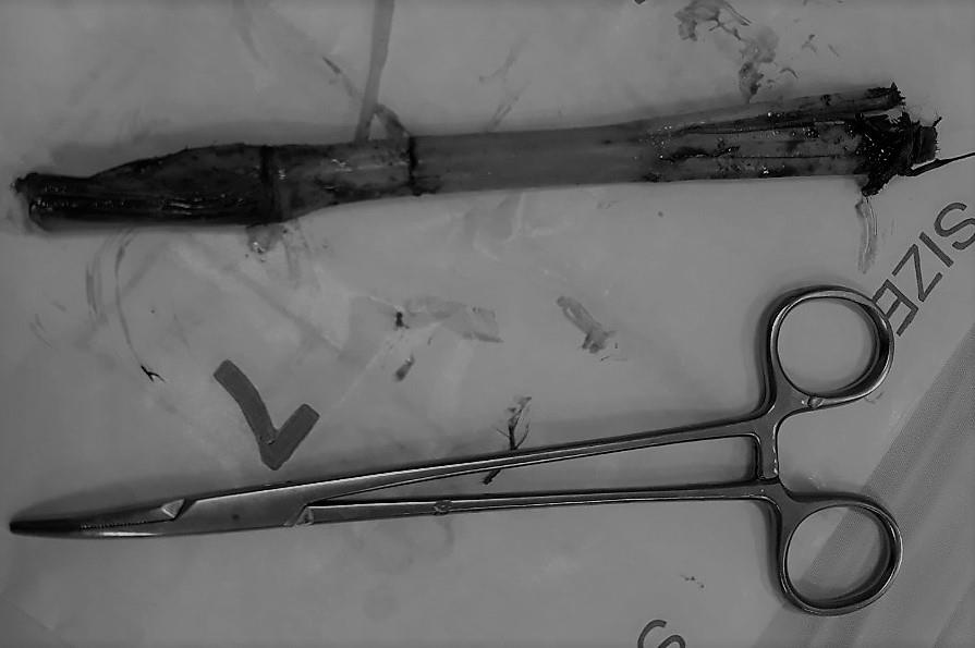 Be trai 8 tuoi bi co voi dam xuyen thanh bung hinh anh