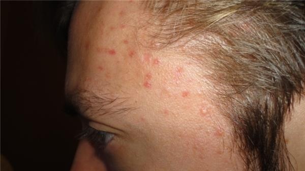 Nhap vien vi benh ung thu ac tinh sau khi nan mun tren tran hinh anh