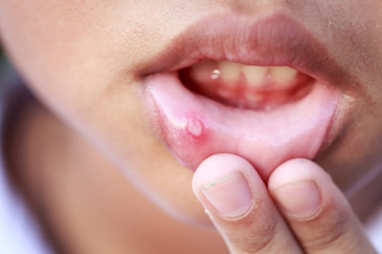 bị giang mai do quan hệ tình dục đồng tính ảnh 1 bi giang mai do quan he tinh duc dong tinh anh 1