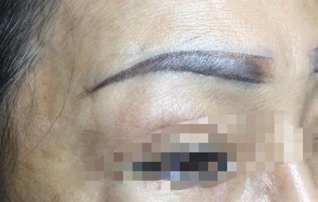 tai biến sau phẫu thuật thẩm mỹ ảnh 2 tai bien sau phau thuat tham my anh 2