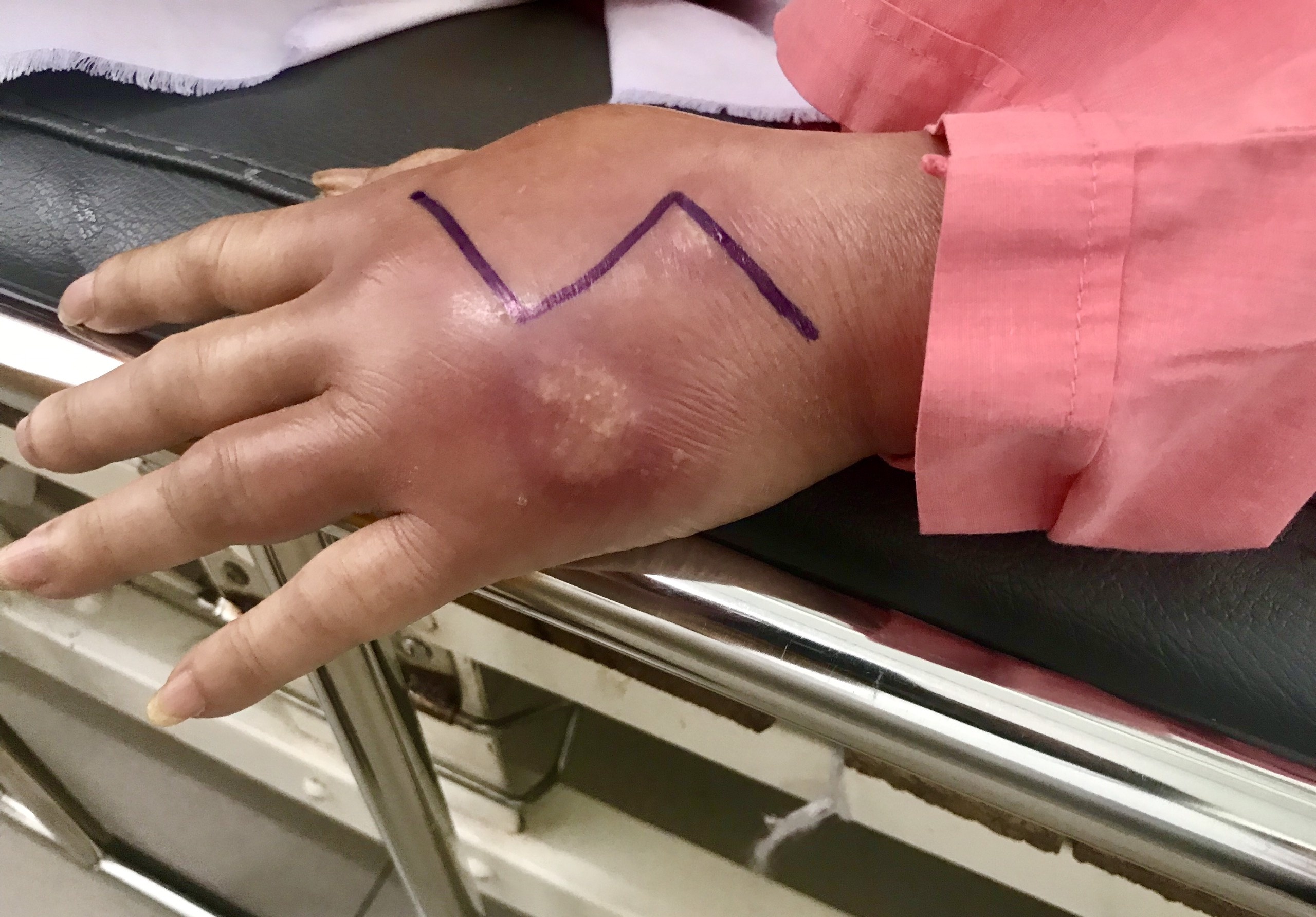 mu mat sau khi tiem filler anh 1