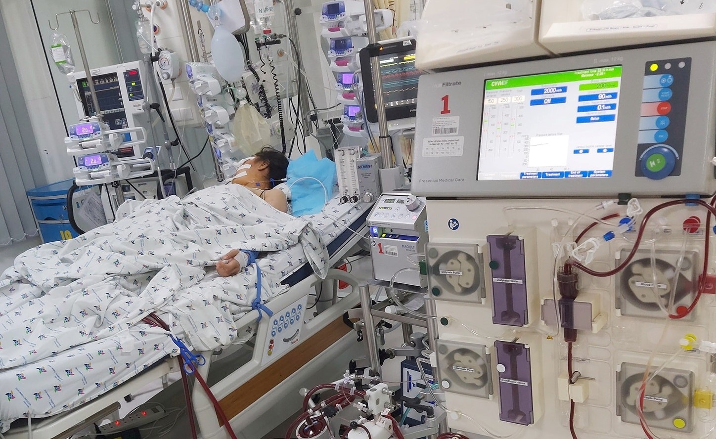 bé gái viêm cơ tim tối cấp ảnh 1 be gai viem co tim toi cap anh 1