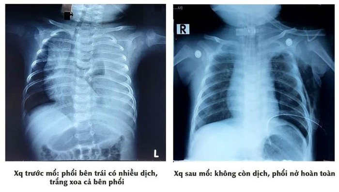 be trai bi tran dich mang phoi anh 1