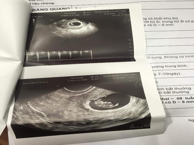 Vu hut mo bung cho thai phu: Tham my vien bi phat 155 trieu dong hinh anh