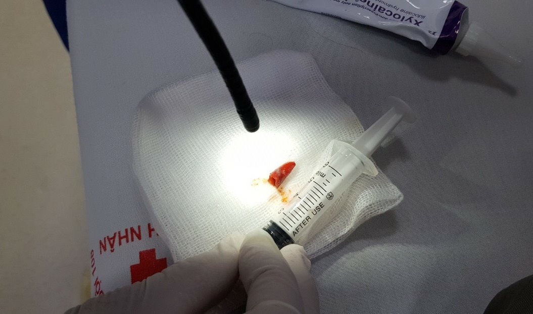 miếng ớt kẹt trong đường thở ảnh 1 mieng ot ket trong duong tho anh 1