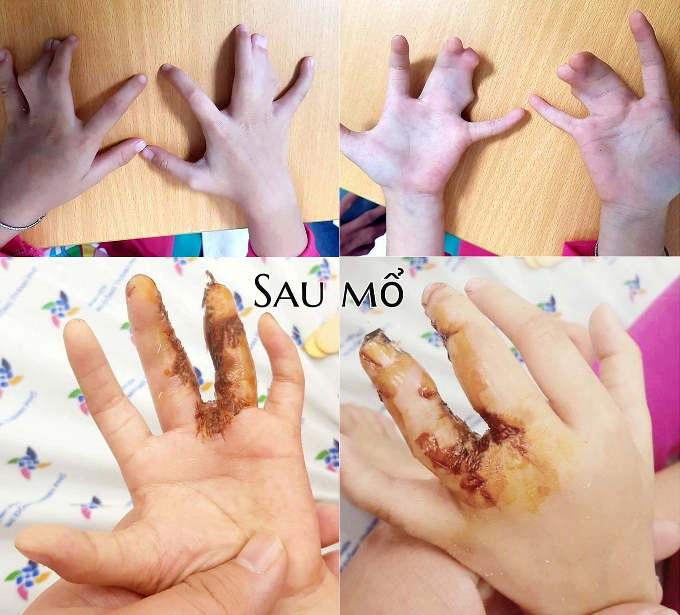 gia đình Tiền Ging hội chứng càng tôm hùm ảnh 1 gia dinh Tien Ging hoi chung cang tom hum anh 1
