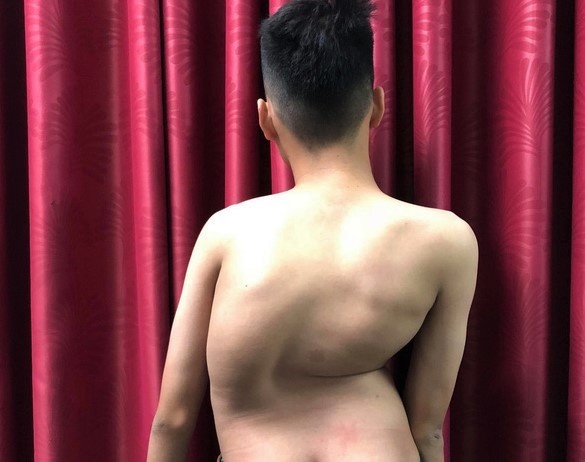 Chang trai 17 tuoi cao them 8 cm sau ca mo veo cot song hinh anh