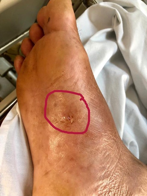 uốn ván gì giẫm gai ảnh 1 uon van gi giam gai anh 1