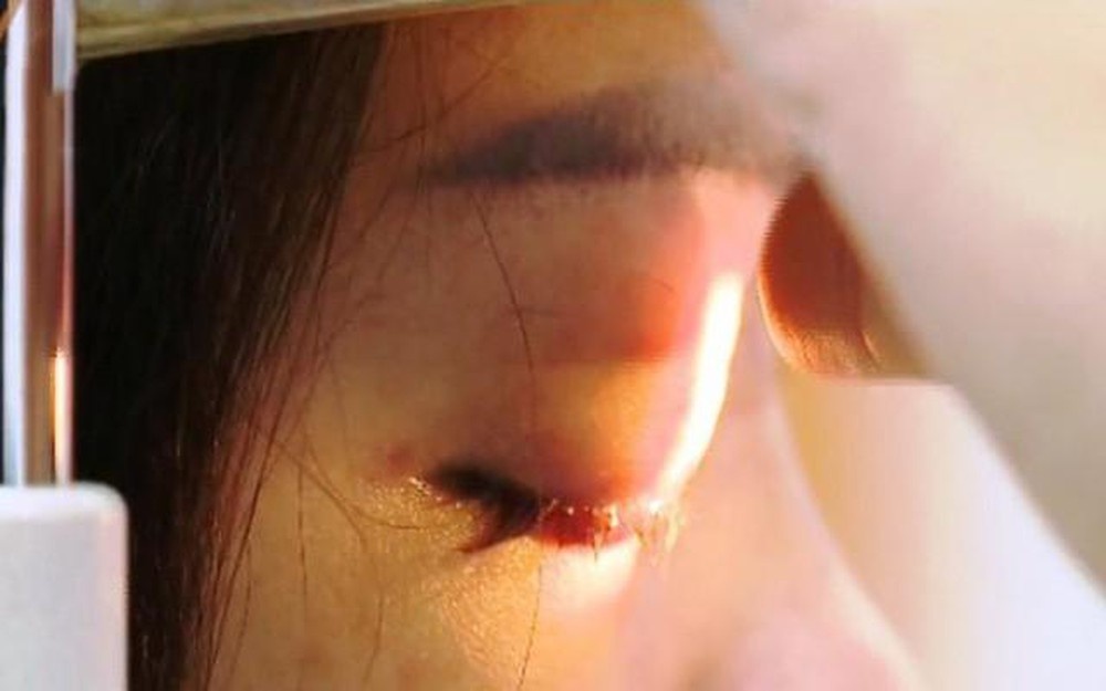 Tiem filler nang mui lam dep don Tet, benh nhan 15 tuoi mu mat hinh anh