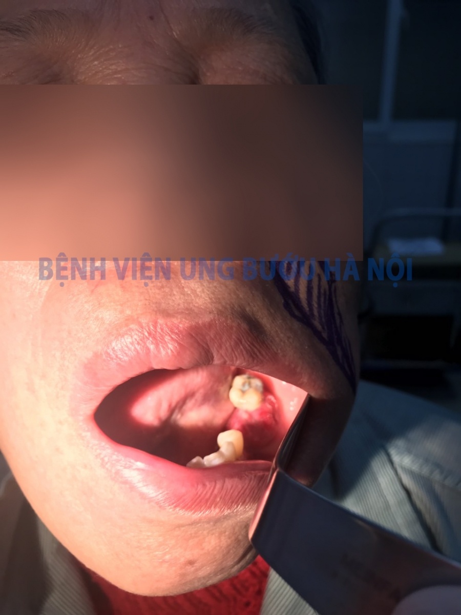 ung thu loi ham di can anh 1