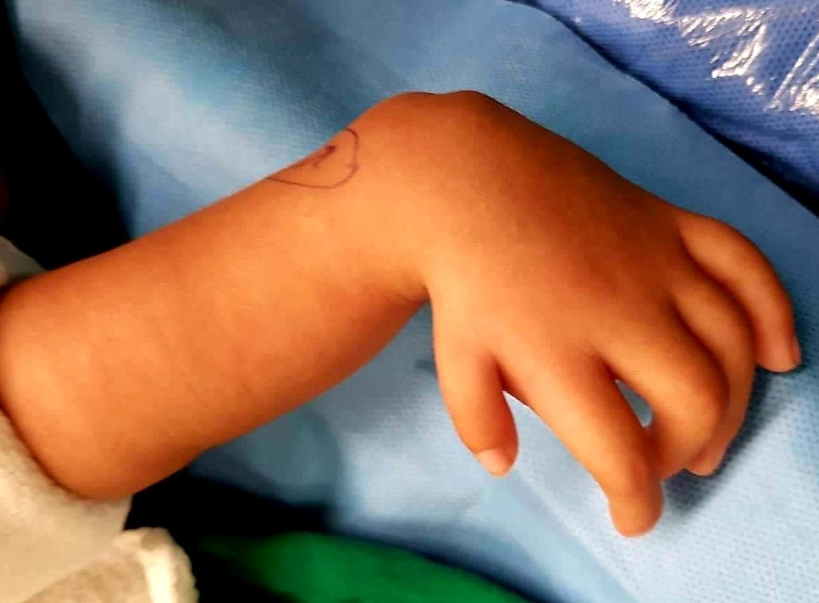 Be trai o Tien Giang co ban tay khoeo hinh chu L hinh anh