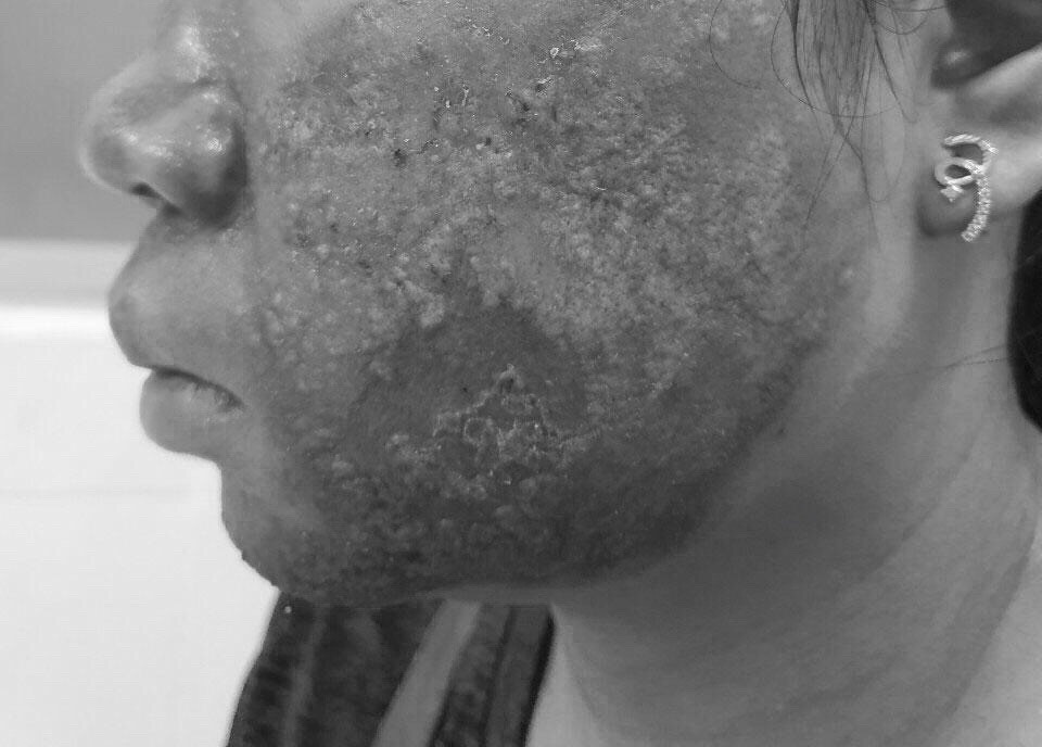 Da mat nhiem trung, mung mu sau khi lan kim tai spa hinh anh